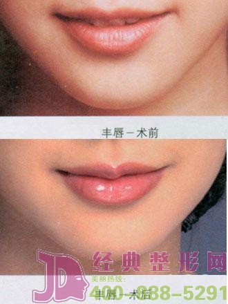 注射丰唇有副作用么？