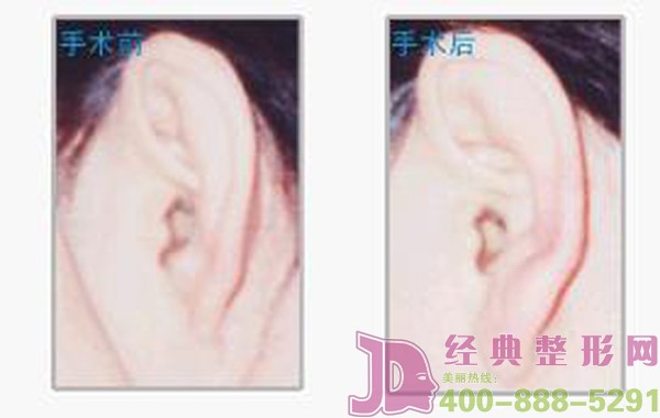 隱耳整形還你一個漂亮耳朵