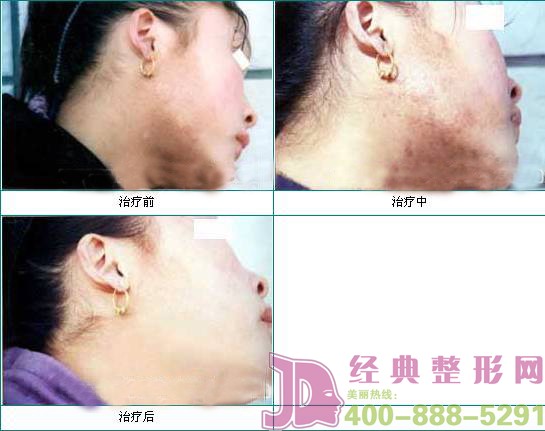 疤痕修复前后
