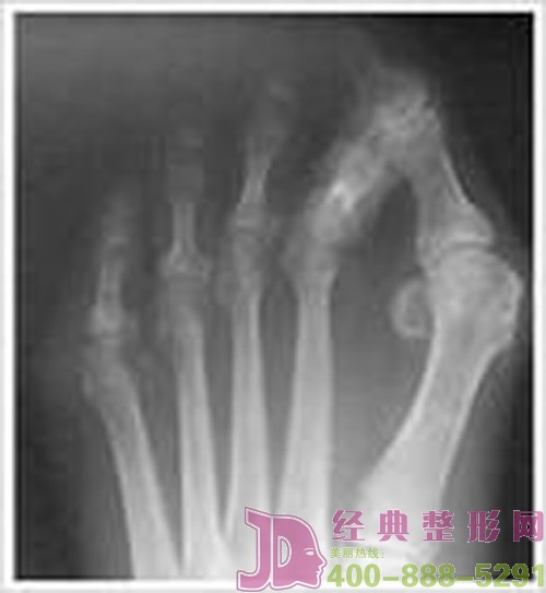 大脚骨的症状介绍
