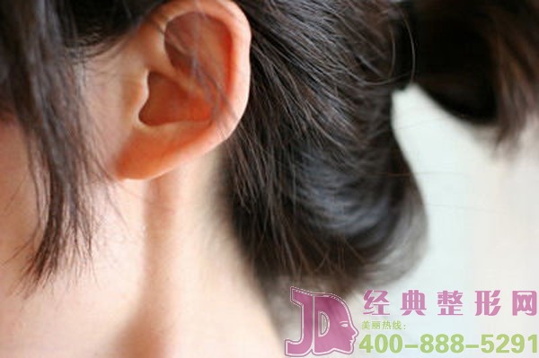 招风耳整形须要了解的内容