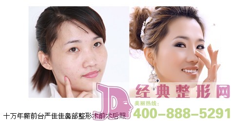 名韩福州整形3月25-27日韩国微雕美鼻大师李奎昊亲诊