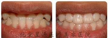 牙齿畸形矫正前后对比图