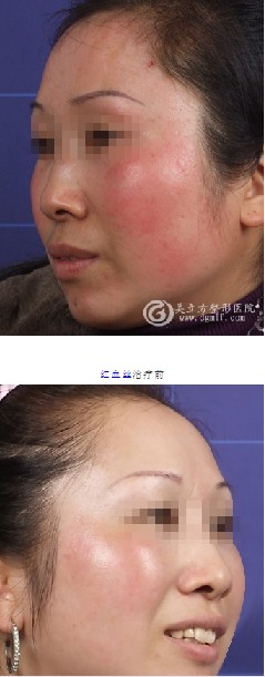 红血丝治疗前后对比图