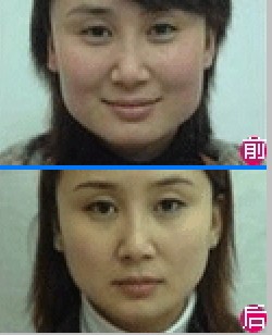 咬肌肥大整形术前后对比图