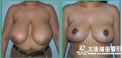 巨乳症产生的主要症状有哪些？
