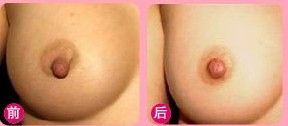 哈尔滨乳头缩小手术效果图