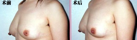 哈尔滨乳头再造手术效果图