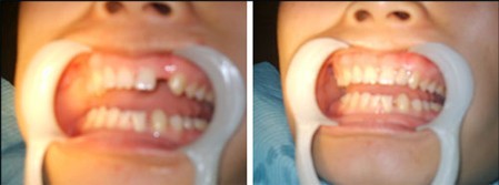 北京种植牙手术成功案例