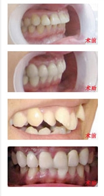 上海儿童牙齿矫正的手术效果图