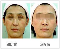 招风耳矫正手术效果图