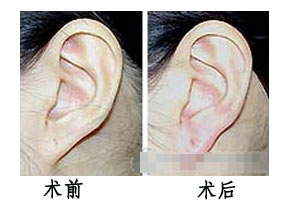 耳垂再造手術(shù)效果圖