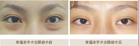 幸福非手术去眼袋成功案例