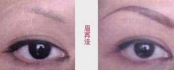 哈爾濱眉再造手術(shù)效果圖