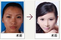 脸型包括求美者面部骨骼角度,厚度及外翻情况的准确数据,通过三维视图