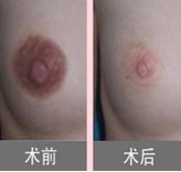 深圳乳头缩小案例