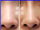 隆鼻术案例