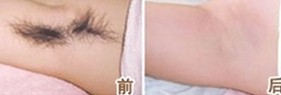 脱毛案例