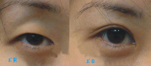 双眼皮术案例