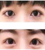 去眼袋案例