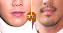 胡须移植案例