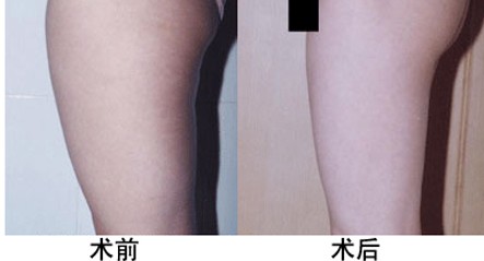 大腿吸脂案例