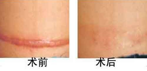 疤痕整形案例