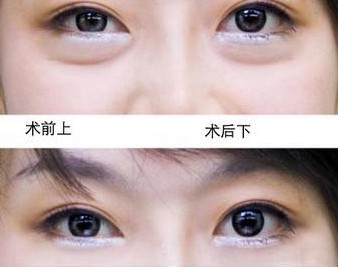 手术祛眼袋案例