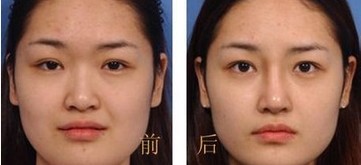 隆鼻案例