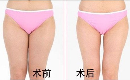 大腿吸脂案例