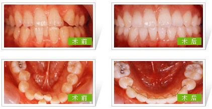 牙齿矫正术案例