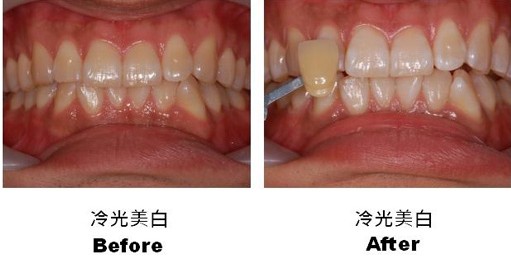 冷光美白手术案例