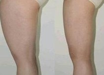 吸脂案例