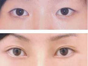 双眼皮案例