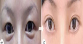 双眼皮案例