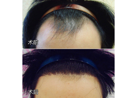 SHT+FUE植发术案例