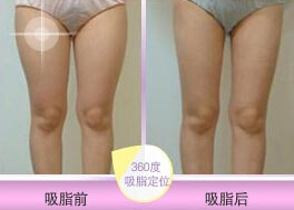 水动力立体吸脂案例