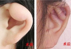 邯鄲耳垂畸形修復(fù)價(jià)格