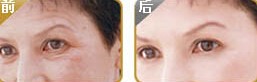邯鄲伊維蘭除皺價(jià)格