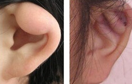 貴陽菜花耳整形正價格