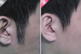 陽(yáng)泉發(fā)際線脫毛價(jià)格