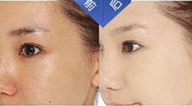 大同激光收縮毛孔價格