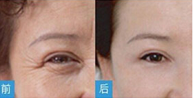 貴陽(yáng)BOTOX除皺價(jià)格