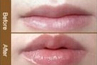 陽泉重唇修整價格