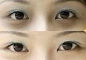 大連去黑眼圈價格