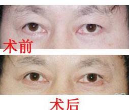 大連眼瞼外翻整復價格