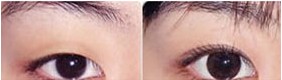 吉林眼瞼下垂矯正價(jià)格