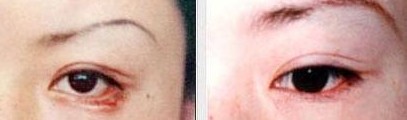 吉林眼瞼外翻矯正價格
