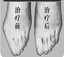 陽泉寬腳變窄價格