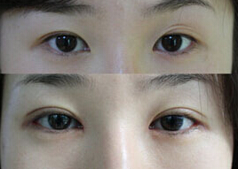 無(wú)錫雙眼皮失敗修復(fù)價(jià)格